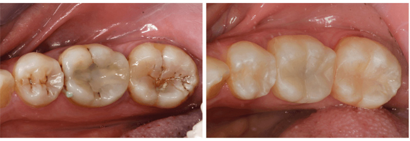 Composite Fillings in High Point