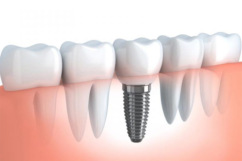 Implants in High Point