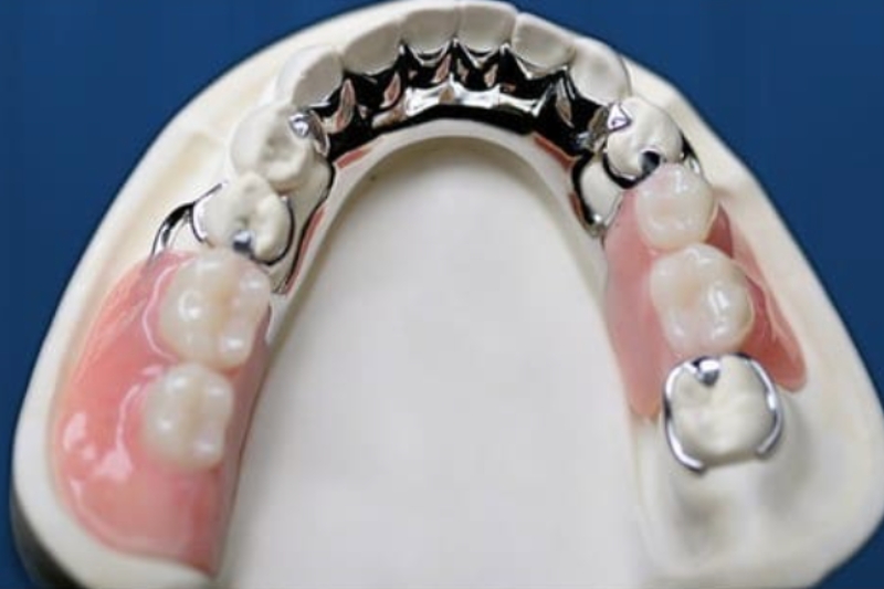 Partial Dentures in High Point