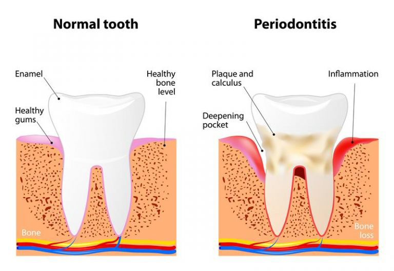 Periodontal Treatment in High Point