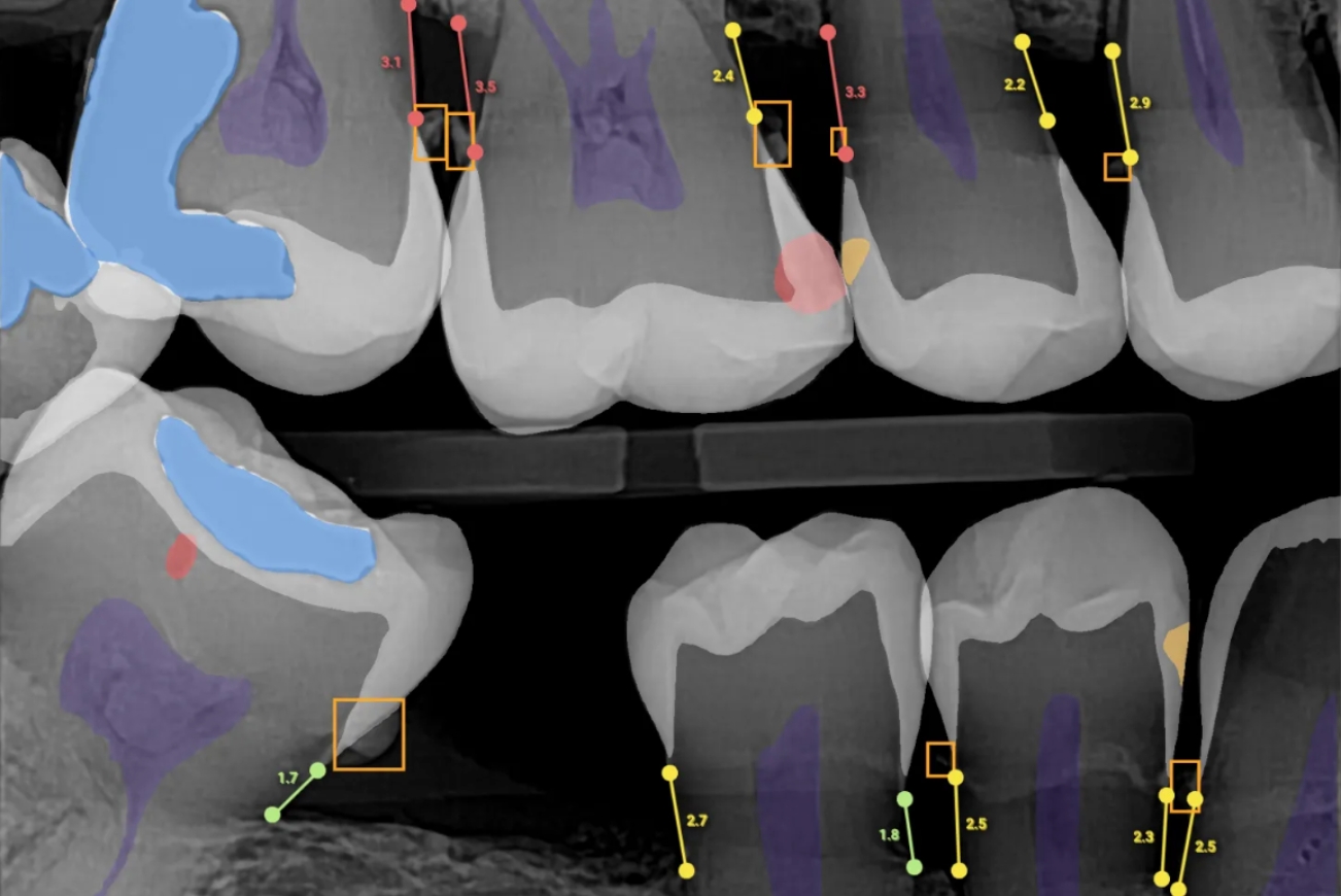 AI Cavity Detection with Overjet in High Point