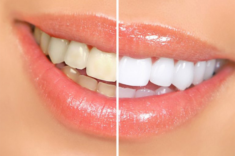 Bleaching/Whitening in High Point