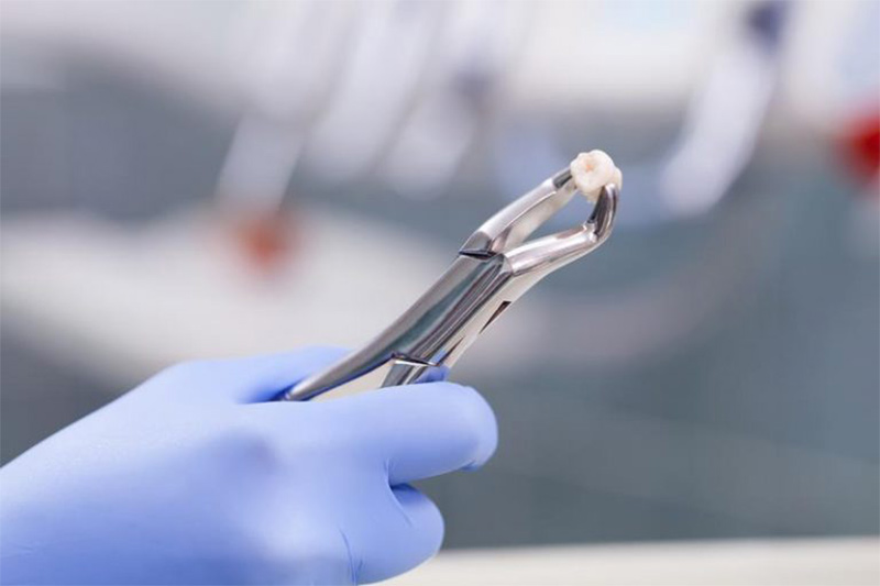 Extractions in High Point