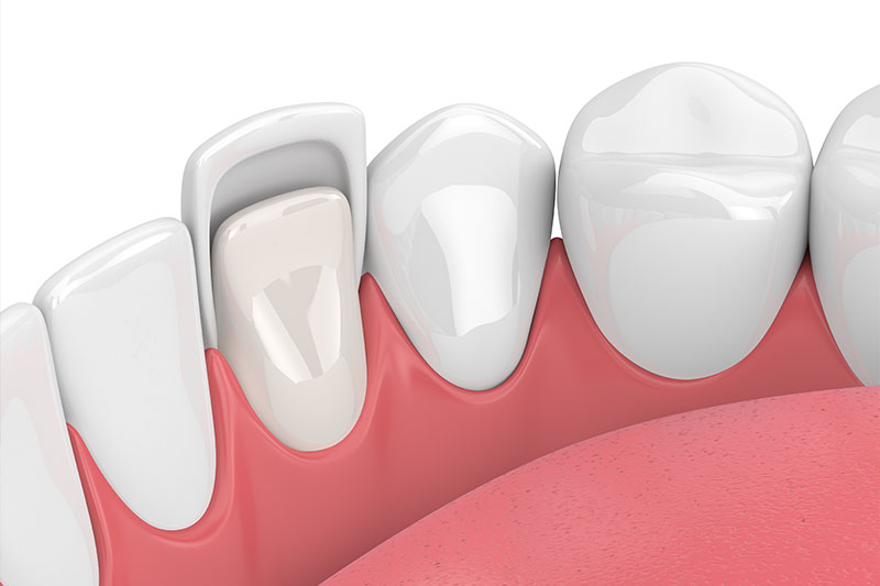 Porcelain Veneers in High Point